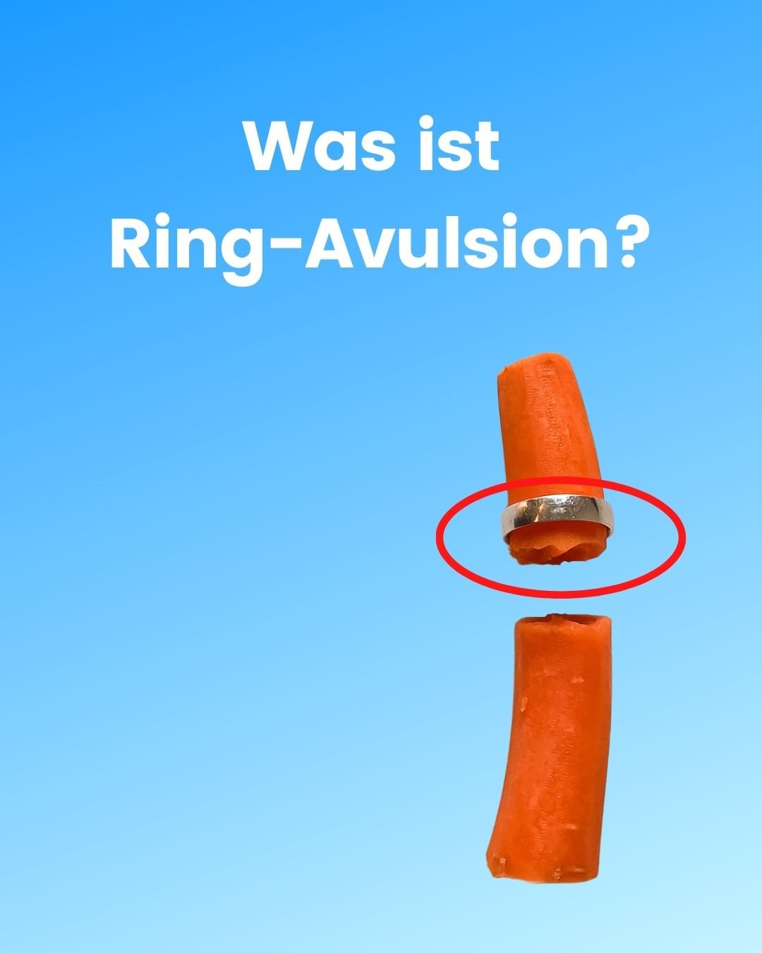 Discover more than 126 ring avulsion images latest - netgroup.edu.vn