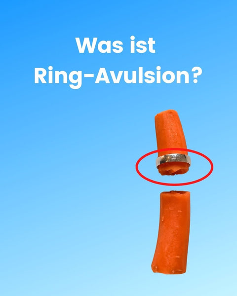 Was ist Ring-Avulsion?